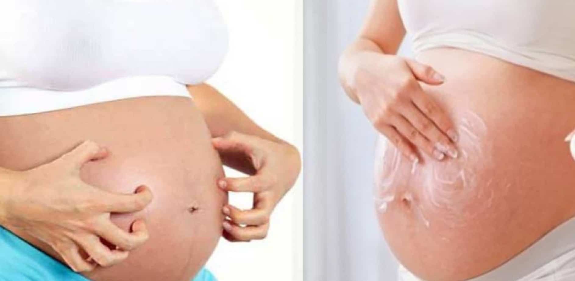 hamilelikte çatlak önleyici krem