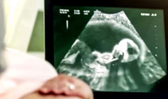crl ne demek bpd nedir hamilelikte olcumler ultrason terimleri