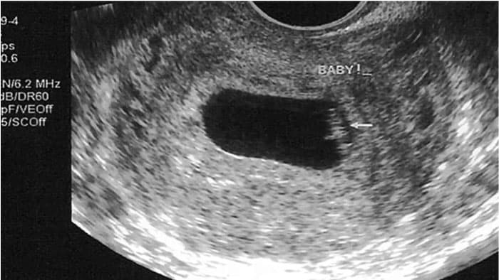 2 Haftalık Gebelik Ultrason Ekranında Görünür Mü?