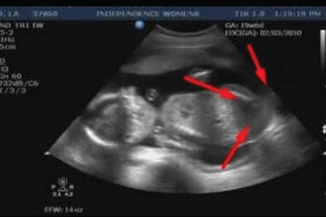 Erkek Bebek Belirtileri Ultrason